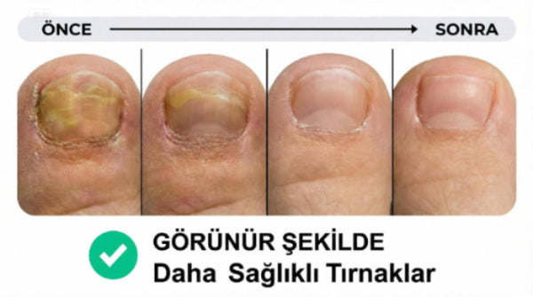 KlearNail Mantar Önleyici Roll-On