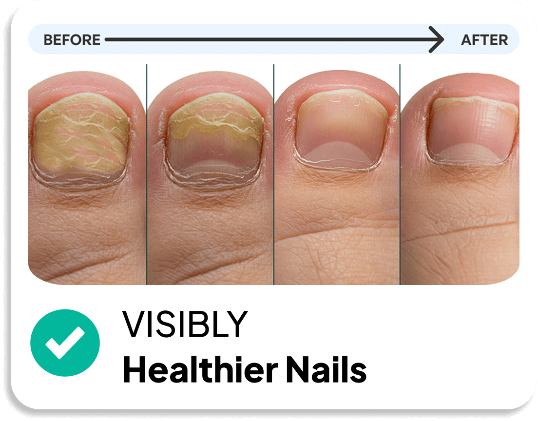 KlearNail Mantar Önleyici Çubuk