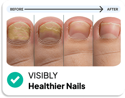 KlearNail Mantar Önleyici Çubuk